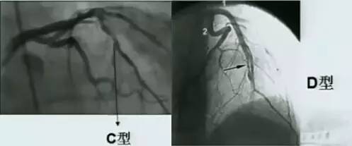 冠脉造影阅片要领 冠脉造影阅片要领
