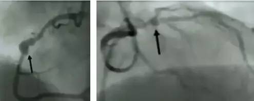冠脉造影阅片要领 冠脉造影阅片要领