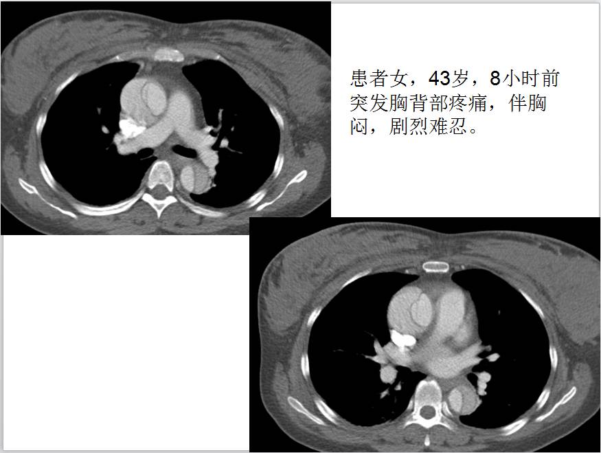 【病例学习】妊娠合并主动脉夹层一例CT影像学表现