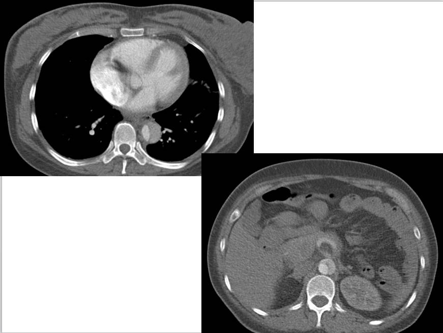 【病例学习】妊娠合并主动脉夹层一例CT影像学表现