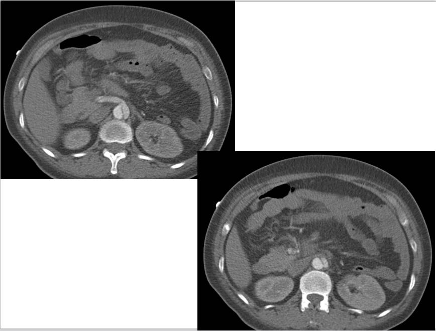 【病例学习】妊娠合并主动脉夹层一例CT影像学表现