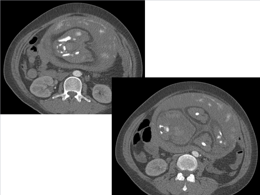 【病例学习】妊娠合并主动脉夹层一例CT影像学表现