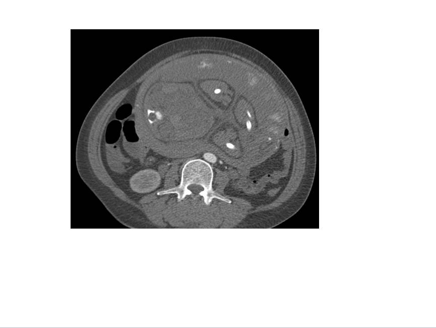 【病例学习】妊娠合并主动脉夹层一例CT影像学表现