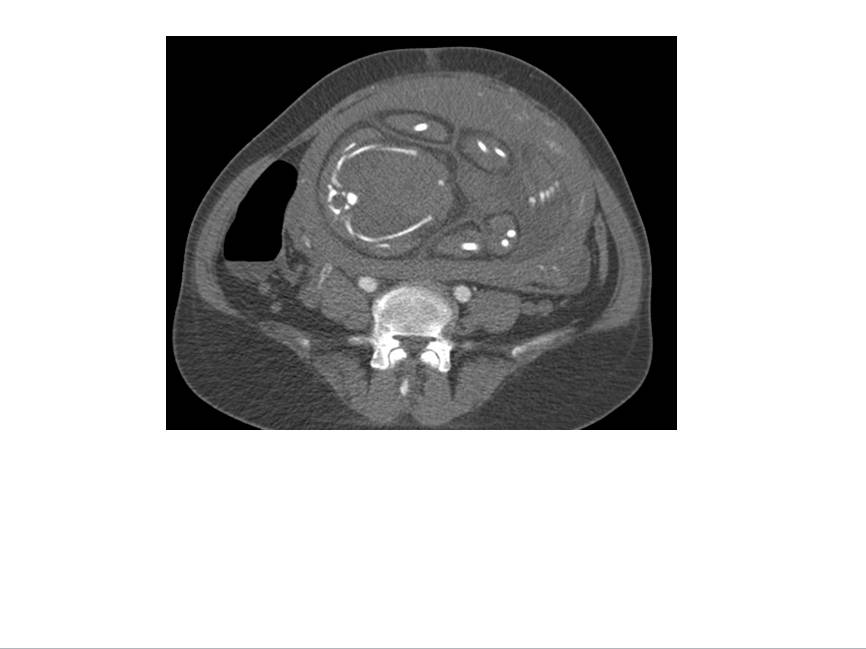 【病例学习】妊娠合并主动脉夹层一例CT影像学表现