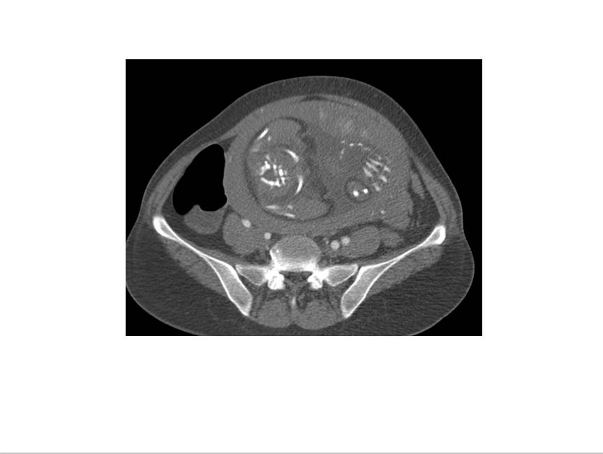 【病例学习】妊娠合并主动脉夹层一例CT影像学表现