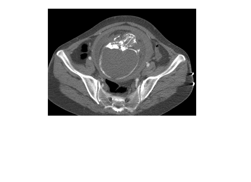 【病例学习】妊娠合并主动脉夹层一例CT影像学表现