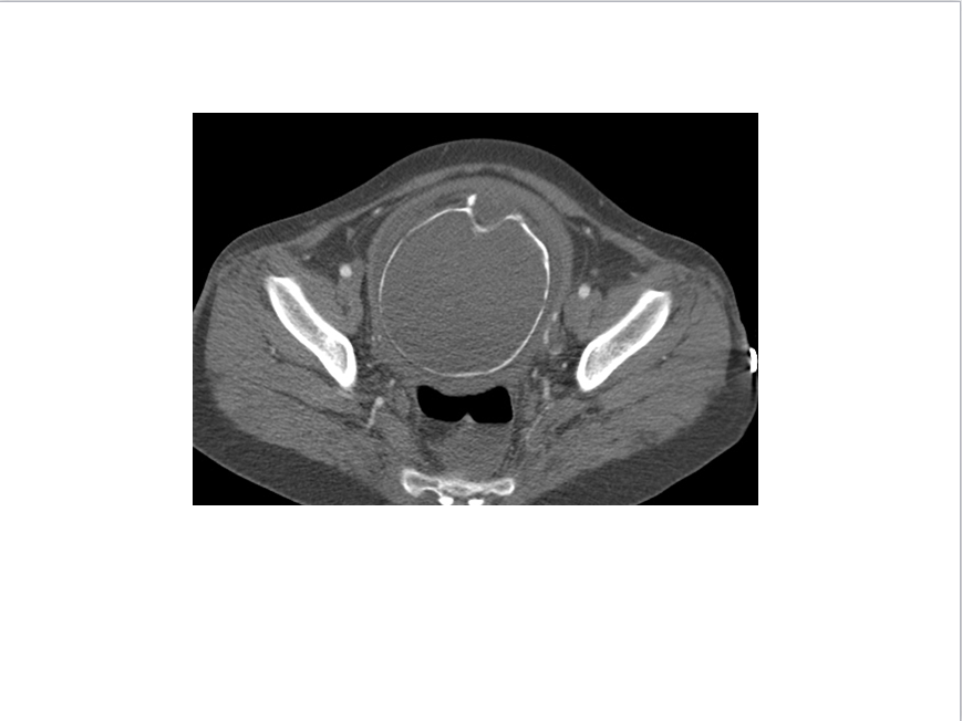 【病例学习】妊娠合并主动脉夹层一例CT影像学表现