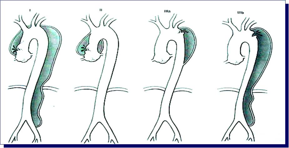 【病例学习】妊娠合并主动脉夹层一例CT影像学表现