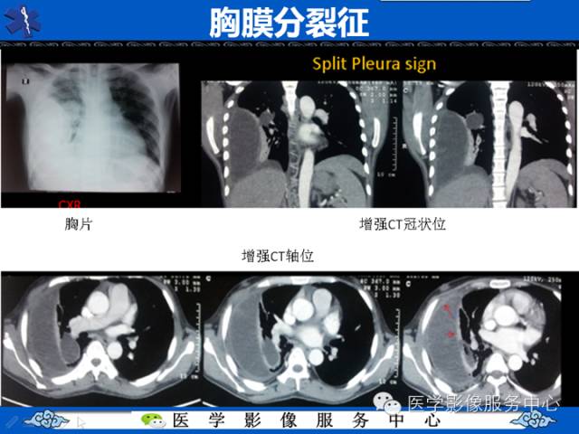 住院医师必知的12个HRCT征象