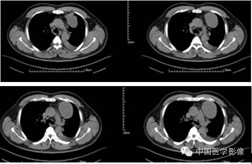 【病例学习】孤立性纤维性肿瘤2例CT影像表现
