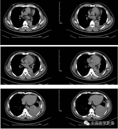 【病例学习】孤立性纤维性肿瘤2例CT影像表现 【病例学习】孤立性纤维性肿瘤2例CT影像表现
