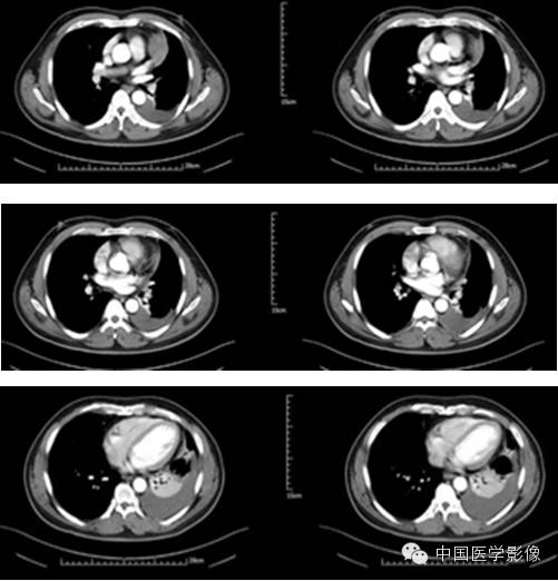 【病例学习】孤立性纤维性肿瘤2例CT影像表现 【病例学习】孤立性纤维性肿瘤2例CT影像表现