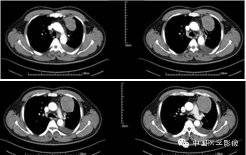 【病例学习】孤立性纤维性肿瘤2例CT影像表现 【病例学习】孤立性纤维性肿瘤2例CT影像表现