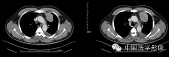 【病例学习】孤立性纤维性肿瘤2例CT影像表现