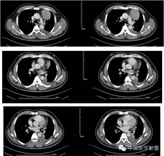 【病例学习】孤立性纤维性肿瘤2例CT影像表现 【病例学习】孤立性纤维性肿瘤2例CT影像表现