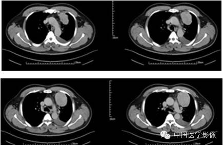 【病例学习】孤立性纤维性肿瘤2例CT影像表现 【病例学习】孤立性纤维性肿瘤2例CT影像表现