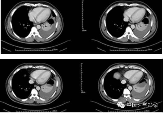 【病例学习】孤立性纤维性肿瘤2例CT影像表现 【病例学习】孤立性纤维性肿瘤2例CT影像表现