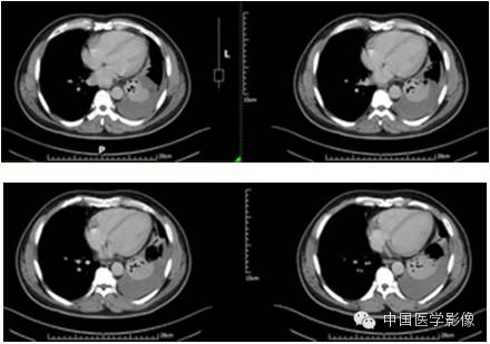 【病例学习】孤立性纤维性肿瘤2例CT影像表现 【病例学习】孤立性纤维性肿瘤2例CT影像表现