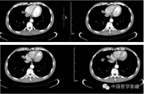 【病例学习】孤立性纤维性肿瘤2例CT影像表现 【病例学习】孤立性纤维性肿瘤2例CT影像表现