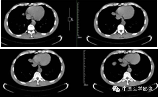 【病例学习】孤立性纤维性肿瘤2例CT影像表现 【病例学习】孤立性纤维性肿瘤2例CT影像表现