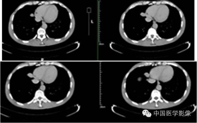 【病例学习】孤立性纤维性肿瘤2例CT影像表现 【病例学习】孤立性纤维性肿瘤2例CT影像表现