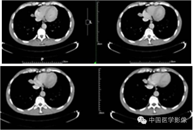 【病例学习】孤立性纤维性肿瘤2例CT影像表现 【病例学习】孤立性纤维性肿瘤2例CT影像表现