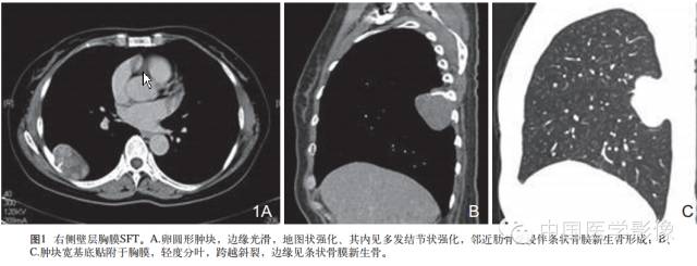 【病例学习】孤立性纤维性肿瘤2例CT影像表现 【病例学习】孤立性纤维性肿瘤2例CT影像表现
