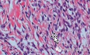 【病例学习】孤立性纤维性肿瘤2例CT影像表现 【病例学习】孤立性纤维性肿瘤2例CT影像表现