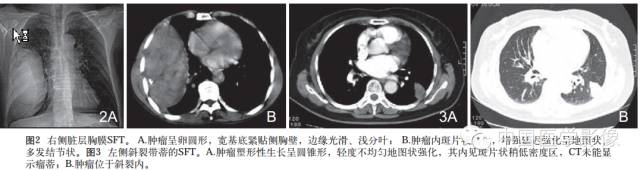 【病例学习】孤立性纤维性肿瘤2例CT影像表现 【病例学习】孤立性纤维性肿瘤2例CT影像表现