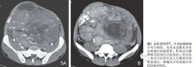 【病例学习】孤立性纤维性肿瘤2例CT影像表现 【病例学习】孤立性纤维性肿瘤2例CT影像表现