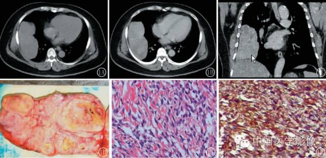 【病例学习】孤立性纤维性肿瘤2例CT影像表现 【病例学习】孤立性纤维性肿瘤2例CT影像表现