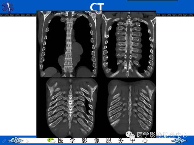 【病例学习】地中海贫血髓外造血一例影像表现