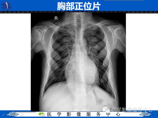 【病例学习】地中海贫血髓外造血一例影像表现