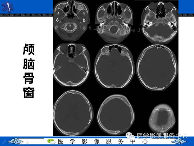 【病例学习】地中海贫血髓外造血一例影像表现