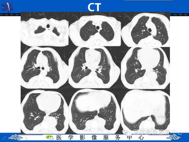 【病例学习】地中海贫血髓外造血一例影像表现