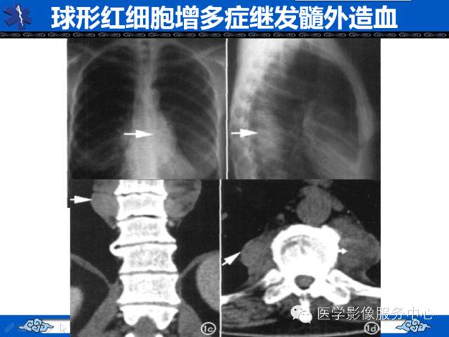 【病例学习】地中海贫血髓外造血一例影像表现