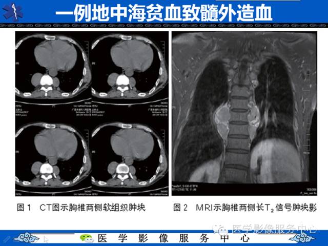 【病例学习】地中海贫血髓外造血一例影像表现