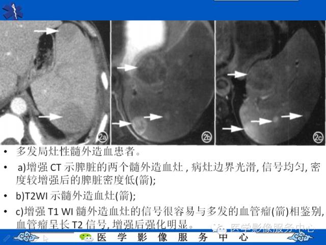【病例学习】地中海贫血髓外造血一例影像表现