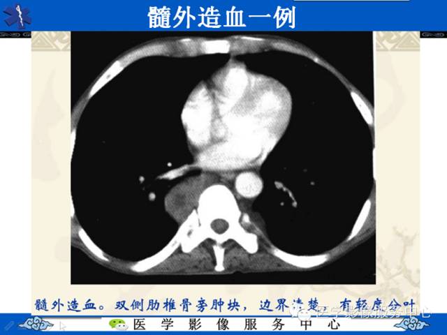 【病例学习】地中海贫血髓外造血一例影像表现