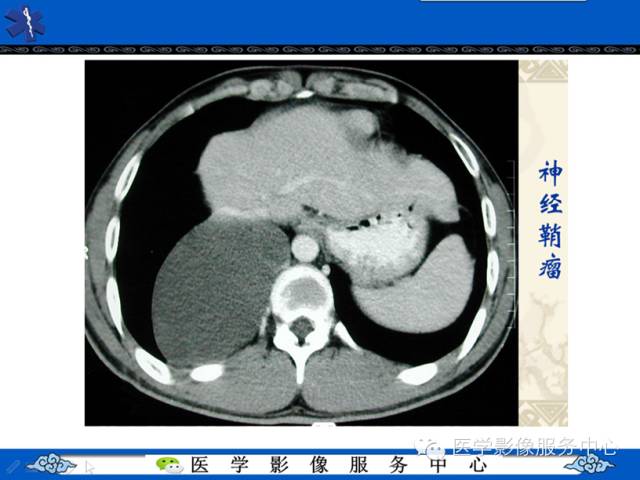 【病例学习】地中海贫血髓外造血一例影像表现