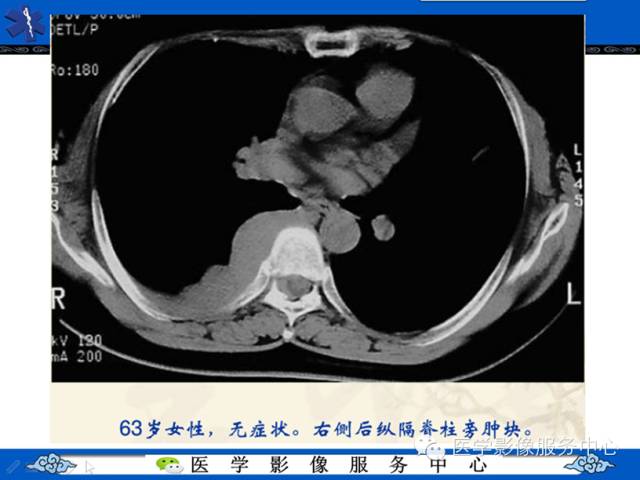 【病例学习】地中海贫血髓外造血一例影像表现