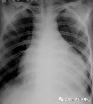 心包积液的影像学检查 心包积液的影像学检查