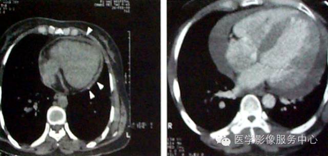 心包积液的影像学检查 心包积液的影像学检查