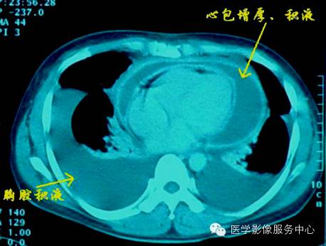 心包积液的影像学检查 心包积液的影像学检查