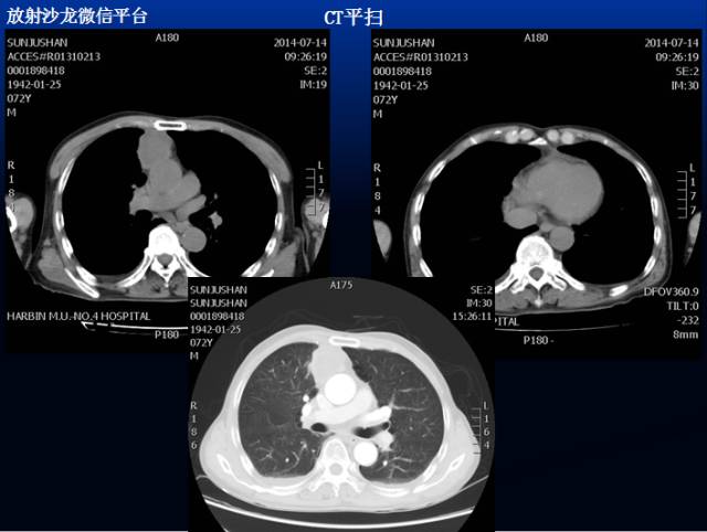 【病例】侵袭性胸腺瘤1例CT影像表现