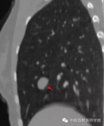 【病例】硬化性血管瘤一例CT影像表现