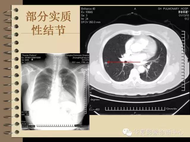 【PPT】早期肺癌影像诊断