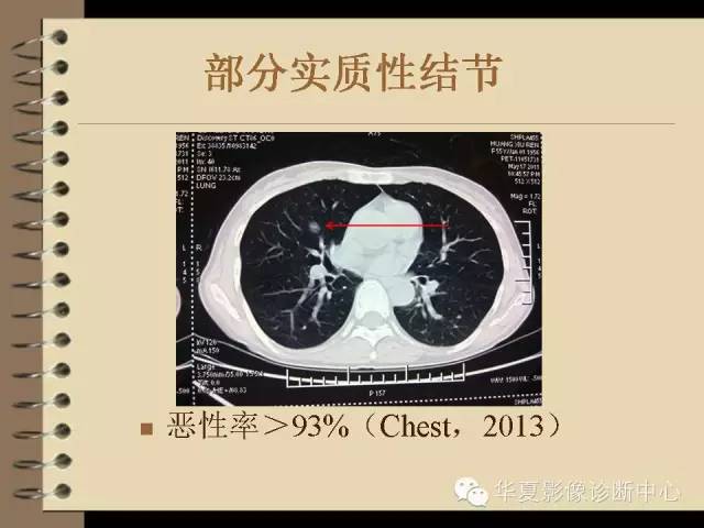 【PPT】早期肺癌影像诊断