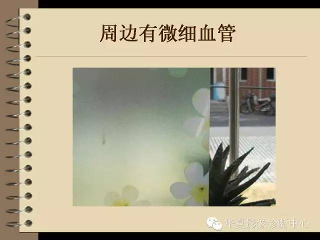 【PPT】早期肺癌影像诊断