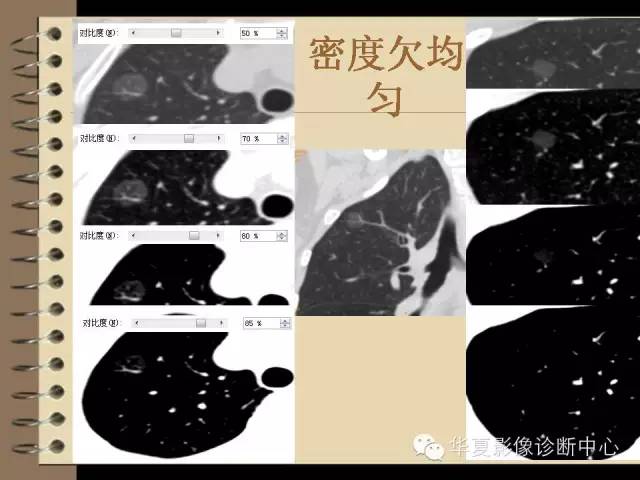 【PPT】早期肺癌影像诊断